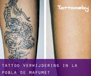 Tattoo verwijdering in la Pobla de Mafumet