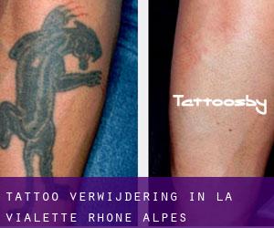 Tattoo verwijdering in La Vialette (Rhône-Alpes)