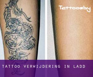 Tattoo verwijdering in Ladd