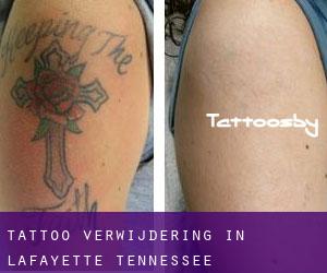 Tattoo verwijdering in Lafayette (Tennessee)