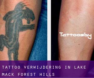 Tattoo verwijdering in Lake Mack-Forest Hills