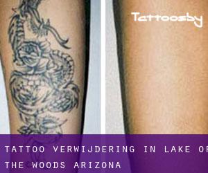 Tattoo verwijdering in Lake of the Woods (Arizona)