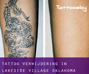 Tattoo verwijdering in Lakeside Village (Oklahoma)