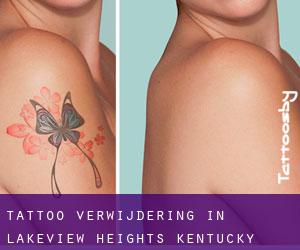 Tattoo verwijdering in Lakeview Heights (Kentucky)