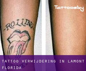 Tattoo verwijdering in Lamont (Florida)
