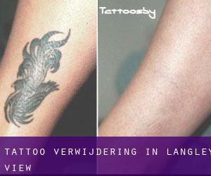 Tattoo verwijdering in Langley View