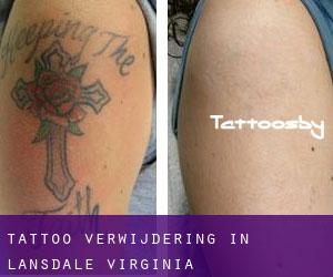 Tattoo verwijdering in Lansdale (Virginia)