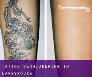 Tattoo verwijdering in Lapeyrouse