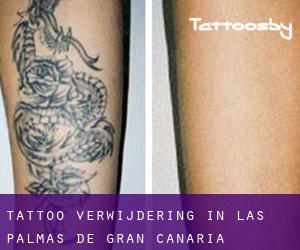 Tattoo verwijdering in Las Palmas de Gran Canaria