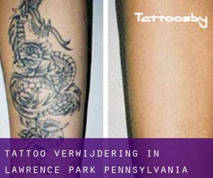 Tattoo verwijdering in Lawrence Park (Pennsylvania)