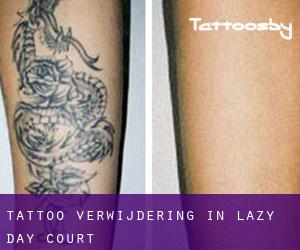 Tattoo verwijdering in Lazy Day Court