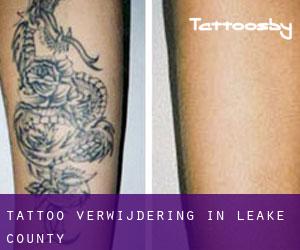 Tattoo verwijdering in Leake County