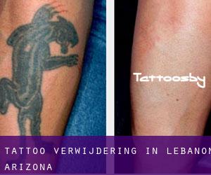 Tattoo verwijdering in Lebanon (Arizona)