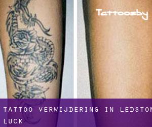Tattoo verwijdering in Ledston Luck