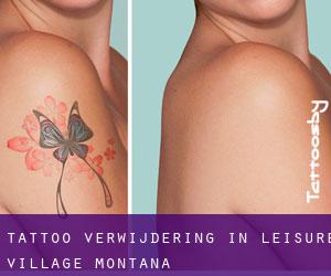 Tattoo verwijdering in Leisure Village (Montana)
