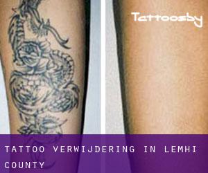 Tattoo verwijdering in Lemhi County