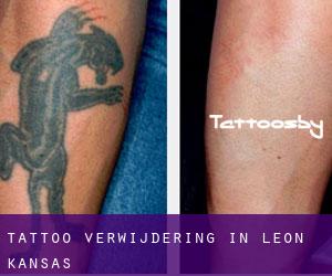 Tattoo verwijdering in Leon (Kansas)
