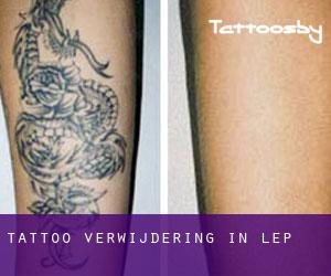 Tattoo verwijdering in Lep