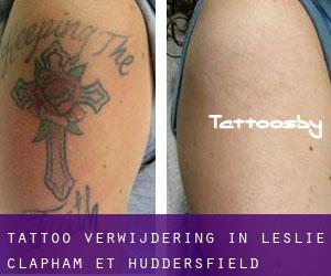 Tattoo verwijdering in Leslie-Clapham-et-Huddersfield