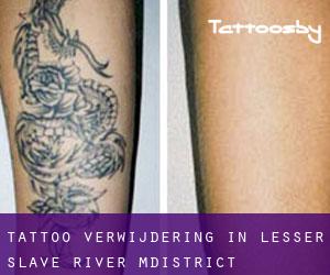 Tattoo verwijdering in Lesser Slave River M.District