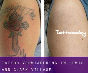 Tattoo verwijdering in Lewis and Clark Village