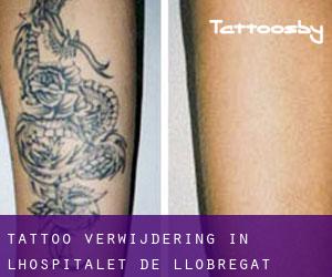 Tattoo verwijdering in L'Hospitalet de Llobregat