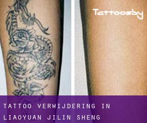 Tattoo verwijdering in Liaoyuan (Jilin Sheng)