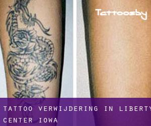 Tattoo verwijdering in Liberty Center (Iowa)