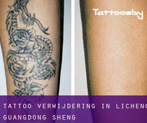 Tattoo verwijdering in Licheng (Guangdong Sheng)