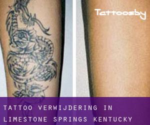 Tattoo verwijdering in Limestone Springs (Kentucky)