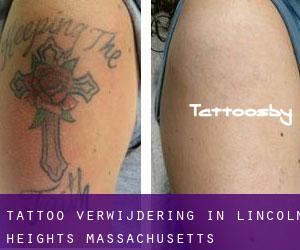 Tattoo verwijdering in Lincoln Heights (Massachusetts)