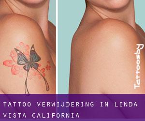 Tattoo verwijdering in Linda Vista (California)
