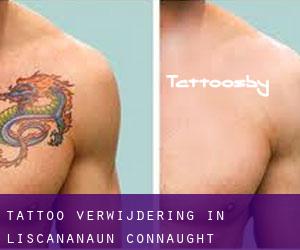 Tattoo verwijdering in Liscananaun (Connaught)