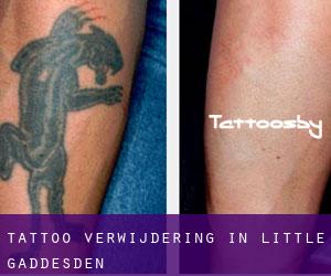 Tattoo verwijdering in Little Gaddesden