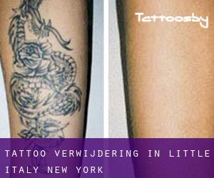 Tattoo verwijdering in Little Italy (New York)