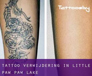 Tattoo verwijdering in Little Paw Paw Lake