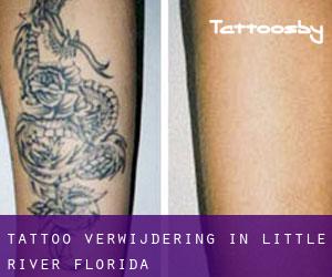 Tattoo verwijdering in Little River (Florida)