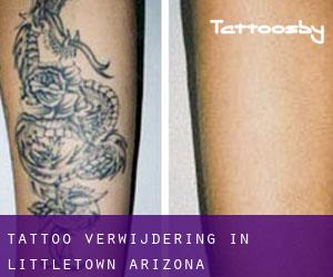 Tattoo verwijdering in Littletown (Arizona)