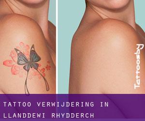 Tattoo verwijdering in Llanddewi Rhydderch