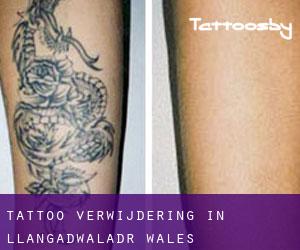 Tattoo verwijdering in Llangadwaladr (Wales)