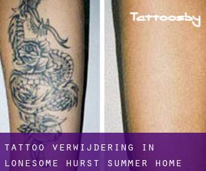 Tattoo verwijdering in Lonesome Hurst Summer Home Area