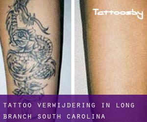 Tattoo verwijdering in Long Branch (South Carolina)
