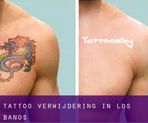 Tattoo verwijdering in Los Banos