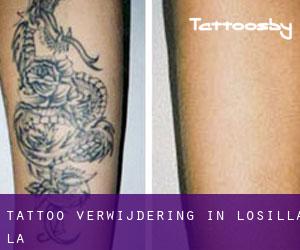 Tattoo verwijdering in Losilla (La)