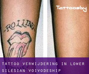 Tattoo verwijdering in Lower Silesian Voivodeship