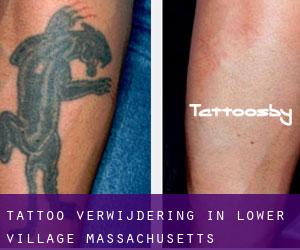 Tattoo verwijdering in Lower Village (Massachusetts)