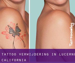 Tattoo verwijdering in Lucerne (California)