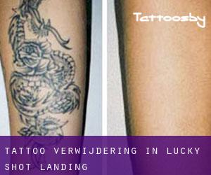 Tattoo verwijdering in Lucky Shot Landing