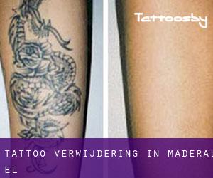 Tattoo verwijdering in Maderal (El)