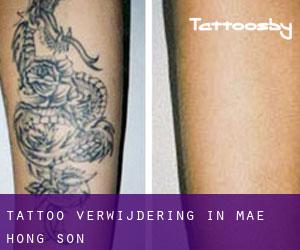 Tattoo verwijdering in Mae Hong Son